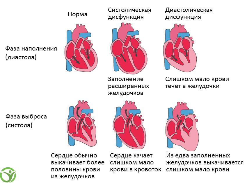 Сердечная недостаточность: симптомы, причины, лечение 