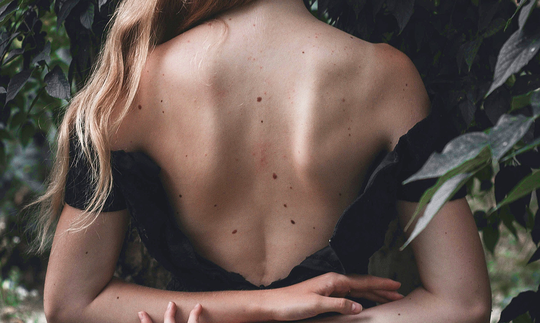 Родимки - меланоцитарні невуси