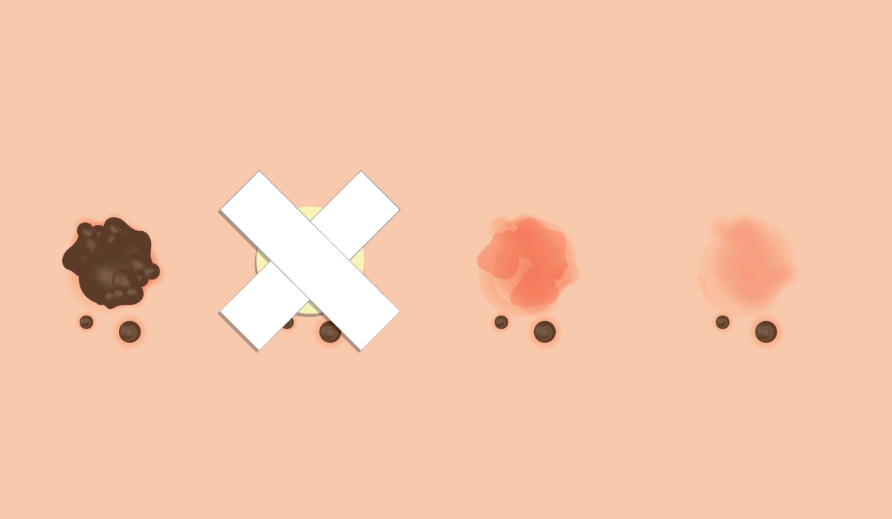 Чому родимки можуть стати небезпечними?